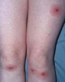 Inflamações da pele causadas por Pulgas